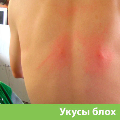 Укусы блох в Армавире