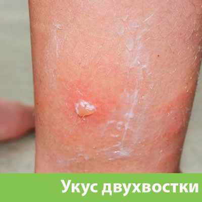 Укус двухвостки в Армавире