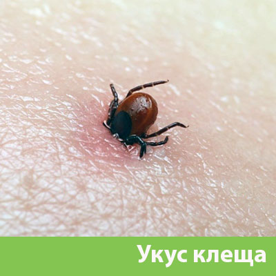 Укус клеща в Армавире