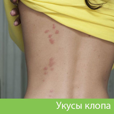 Профессиональное уничтожение клопов в Армавире